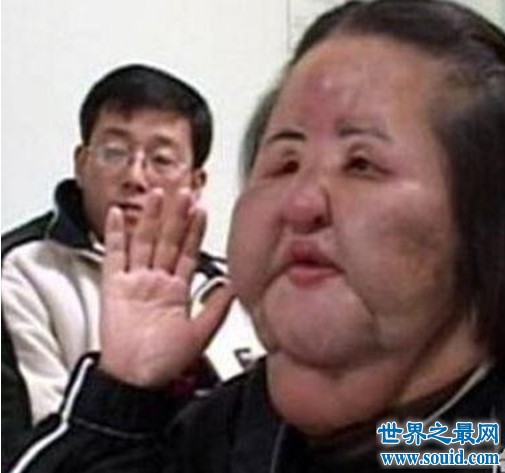 世界十大整容失敗案例，最瘋狂的是取出66克的硅膠?