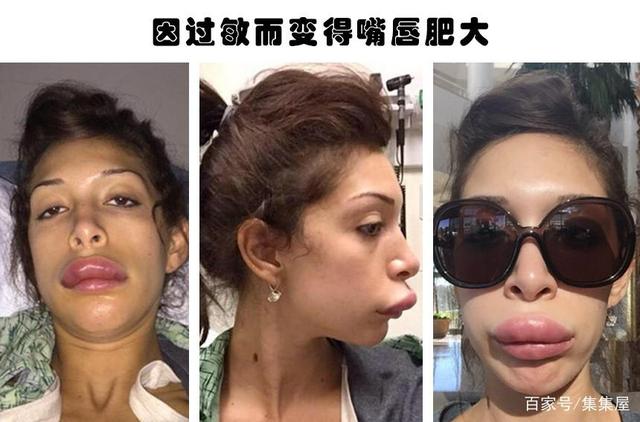 整容失敗的代價：據(jù)說因為整容而毀掉了自己容貌的6個人