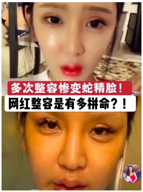 女網(wǎng)紅16歲開始整容，腳后跟都不放過，失敗后稱自己心理已經(jīng)病態(tài)